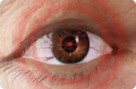 thyroid-eye-disease-pain-rendering