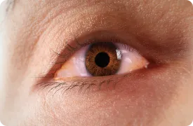 chemosis-rendering