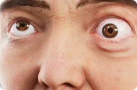 extraocular-muscle-restriction-rendering