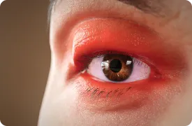 eyelid-erythema-rendering