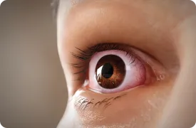 eyelid-retraction-rendering