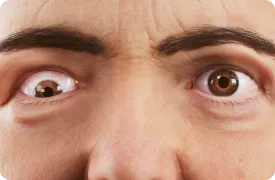 thyroid-eye-disease-strabismus-rendering