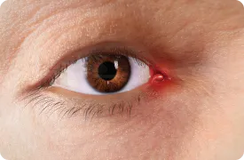 inflammation-caruncle-plica-rendering
